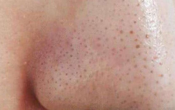 清潔面膜哪個(gè)牌子可以快速祛黑頭？趙薇、薇婭 推薦的紐西之謎泥膜真的好用嗎？